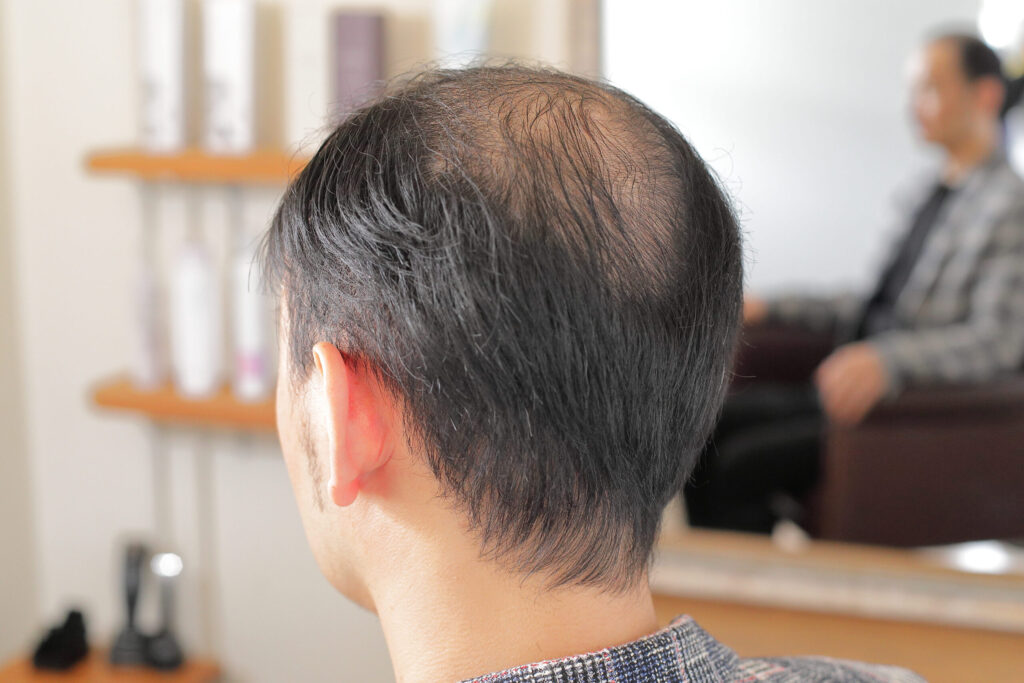 薄毛対策を始めるきっかけランキング１０