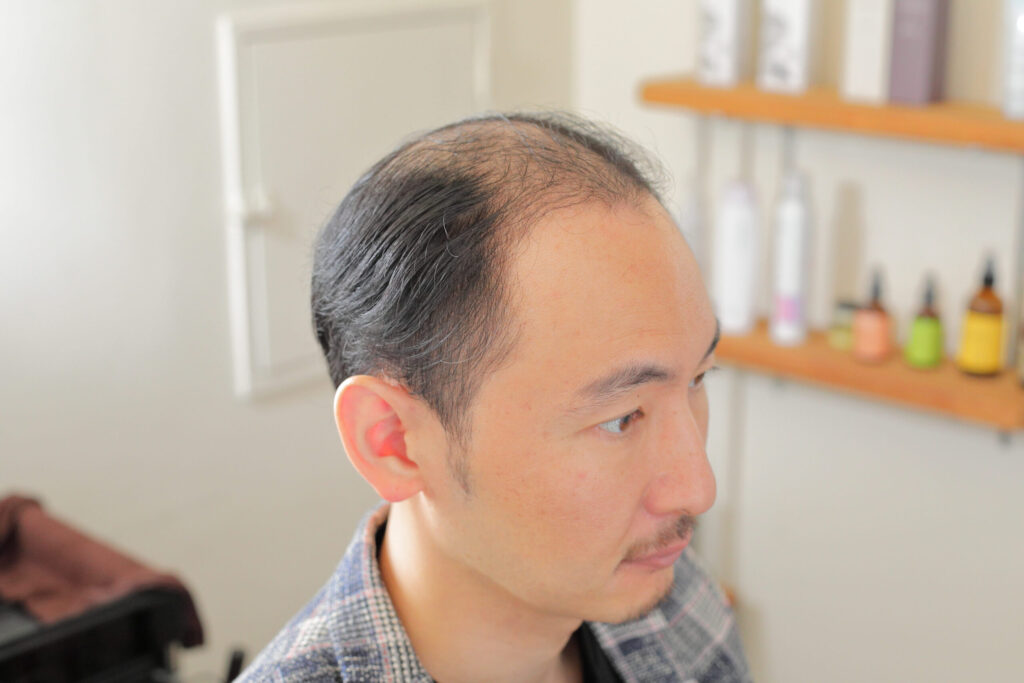 ＡＧＡ治療から、ウィッグにしようと思ったきっかけについて