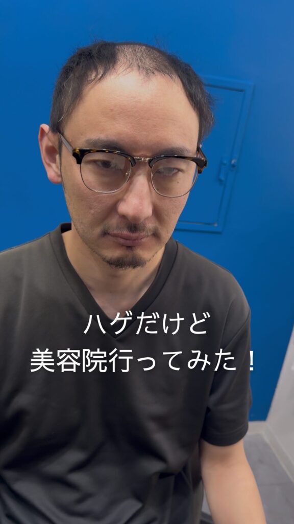 「ハゲだけど美容院行ってみた！」メンズウィッグで変われるってホント？