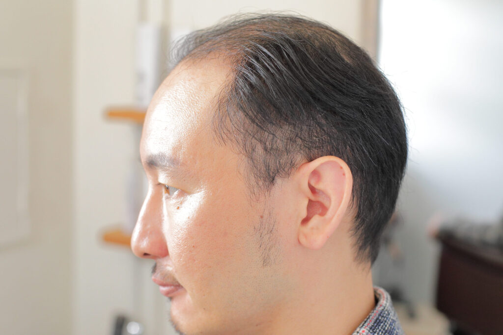 編み込み増毛法について　体験談
