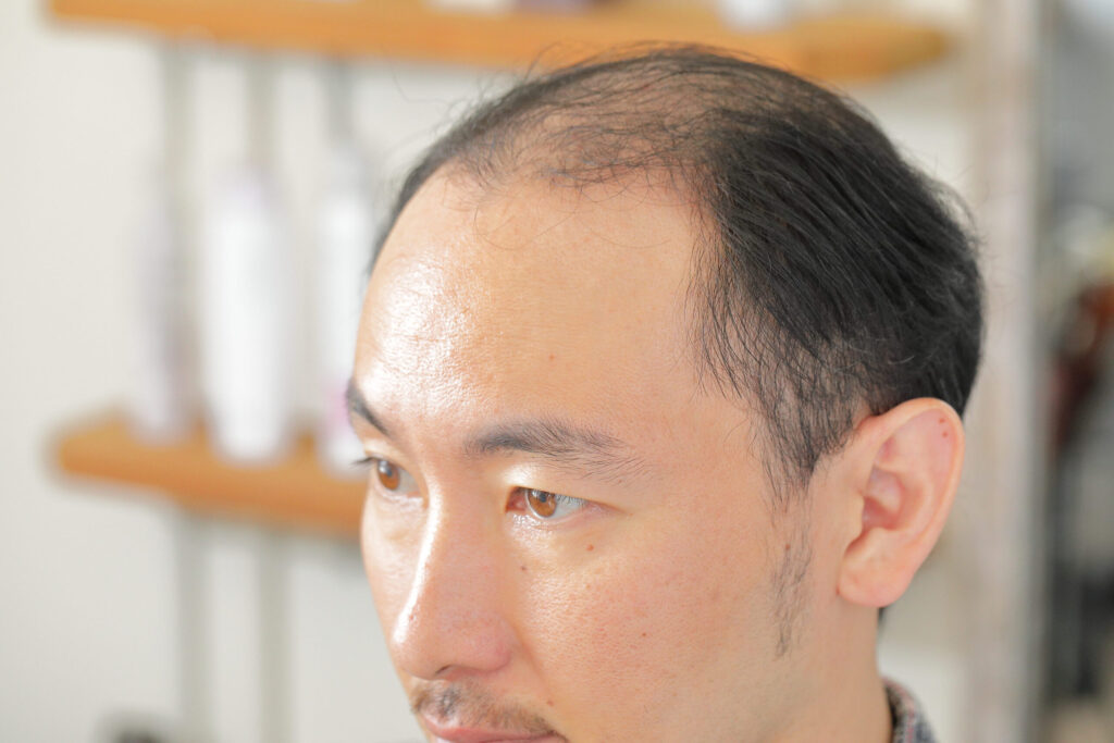 ＡＧＡ治療体験。私のAGAとの戦いについて
